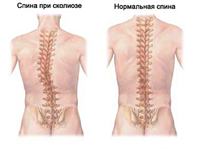 25 июня — Международный день борьбы со сколиозом