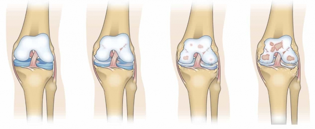 Остеоартроз коленного сустава: новые данные.